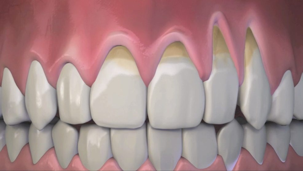 A new fix for unattractive receding gums with SLC dentist Dr. Jared Theurer KUTV